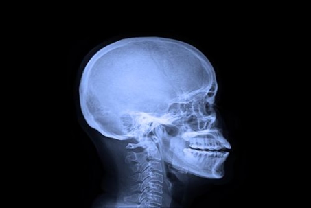 xray of a skull